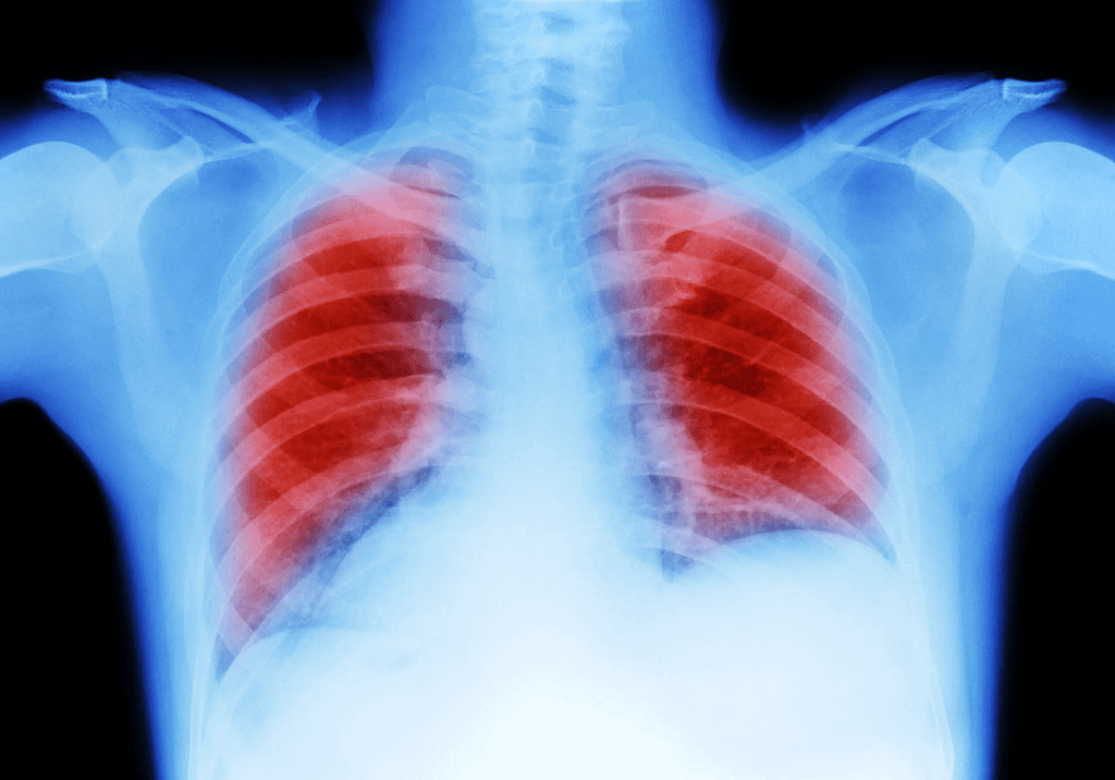 Filing a Lawsuit for Asbestos Exposure in a Mesothelioma Case